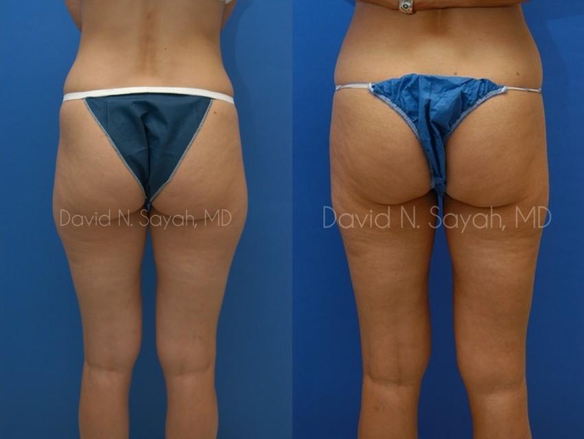 Liposuction Before and After | Sayah Institute
