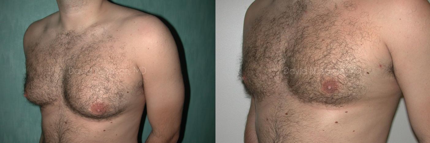 Male Breast Surgery Before and After | Sayah Institute