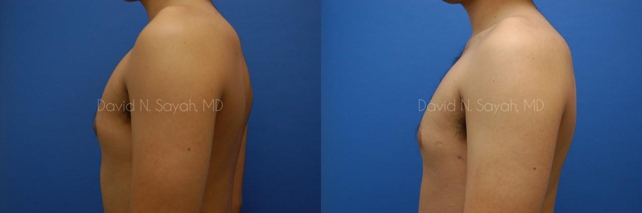 Male Breast Surgery Before and After | Sayah Institute