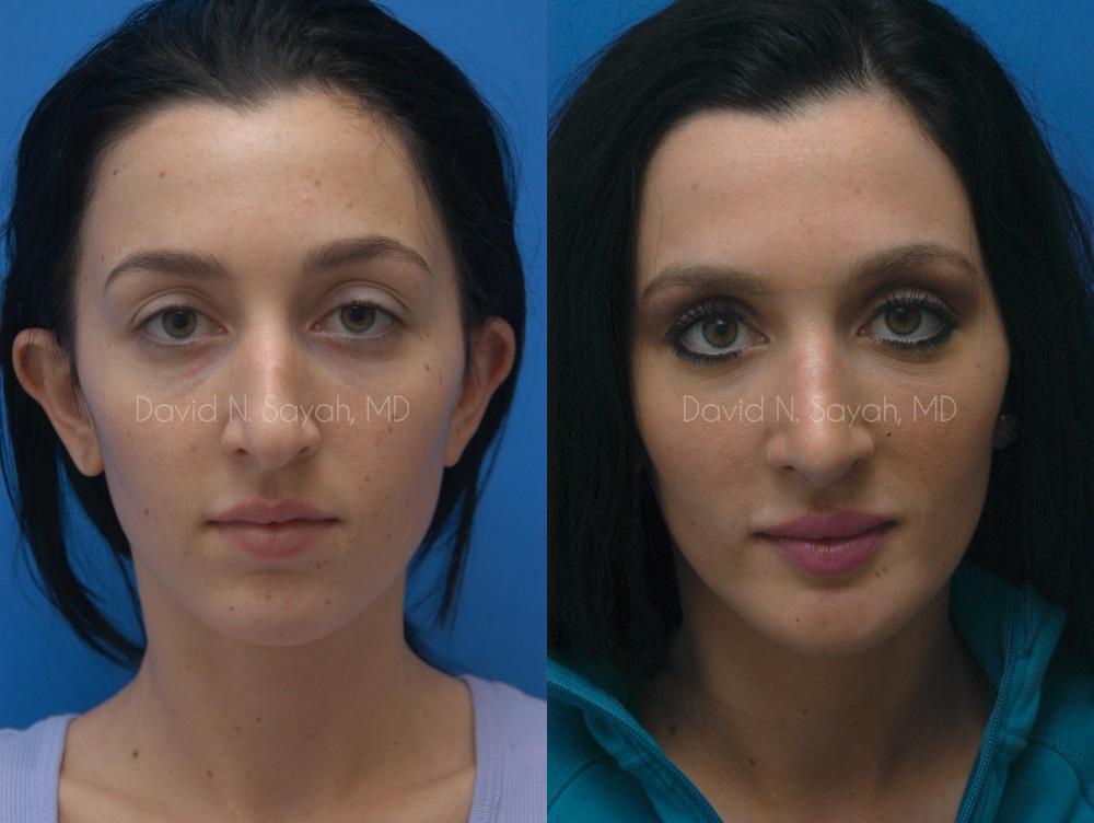 Rhinoplasty Before and After | Sayah Institute