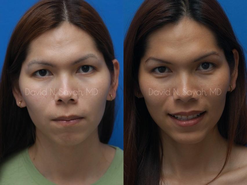 Chin Implant Before and After | Sayah Institute