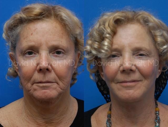 Neck Lift Before and After | Sayah Institute