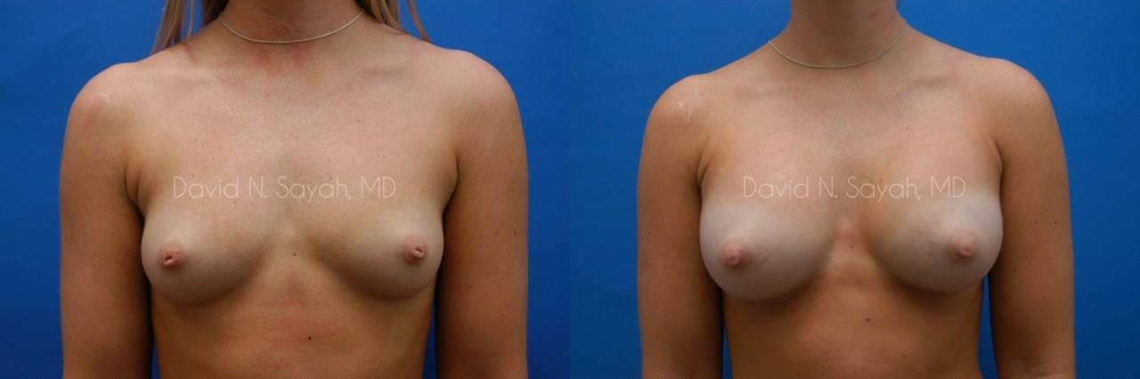 Breast Augmentation Before and After | Sayah Institute