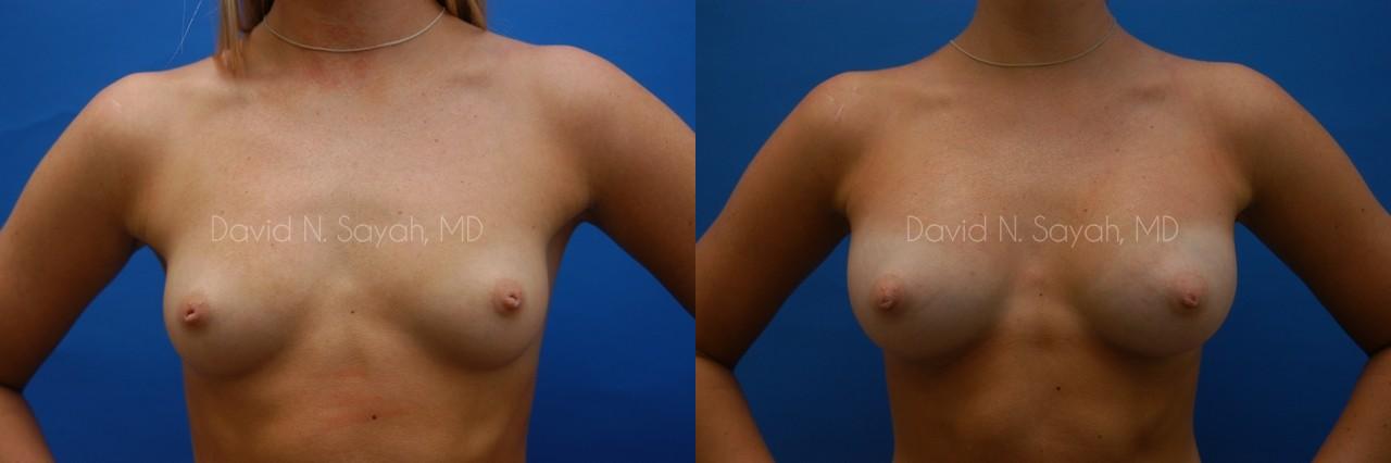 Breast Augmentation Before and After | Sayah Institute