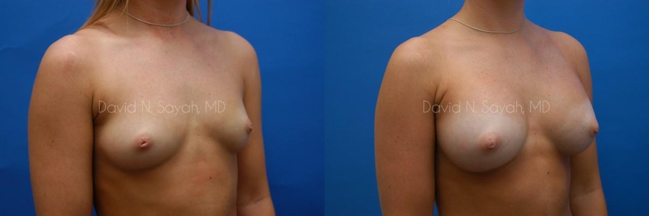 Breast Augmentation Before and After | Sayah Institute