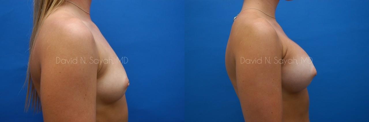 Breast Augmentation Before and After | Sayah Institute