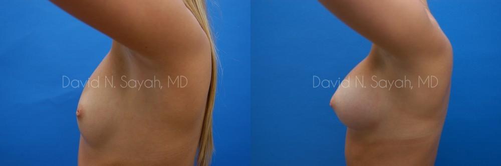 Breast Augmentation Before and After | Sayah Institute