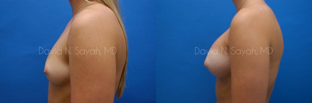 Breast Augmentation Before and After | Sayah Institute