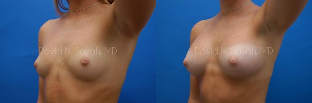 Breast Augmentation Before and After | Sayah Institute