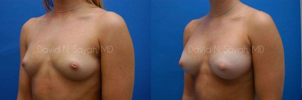 Breast Augmentation Before and After | Sayah Institute
