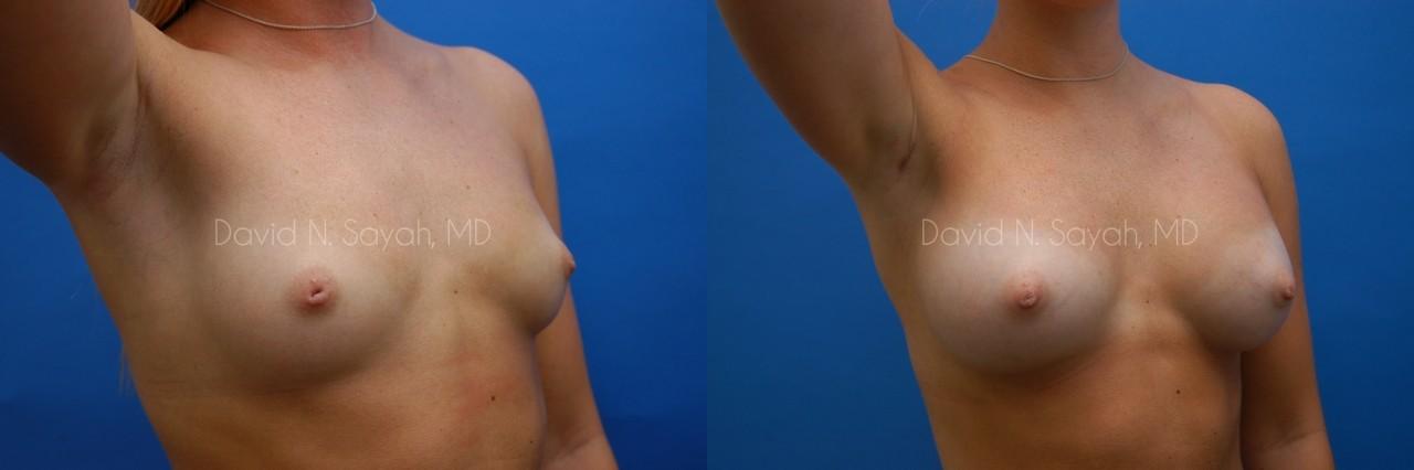 Breast Augmentation Before and After | Sayah Institute