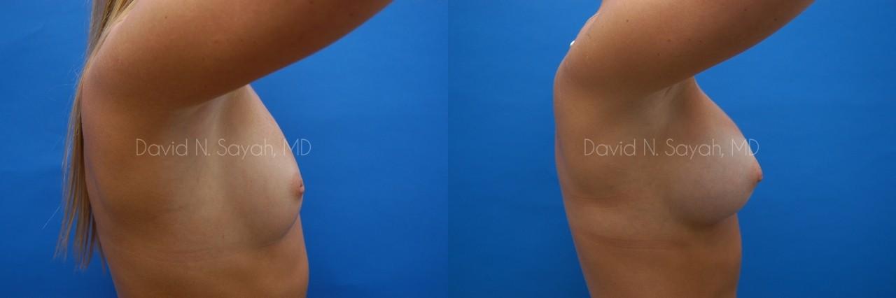 Breast Augmentation Before and After | Sayah Institute
