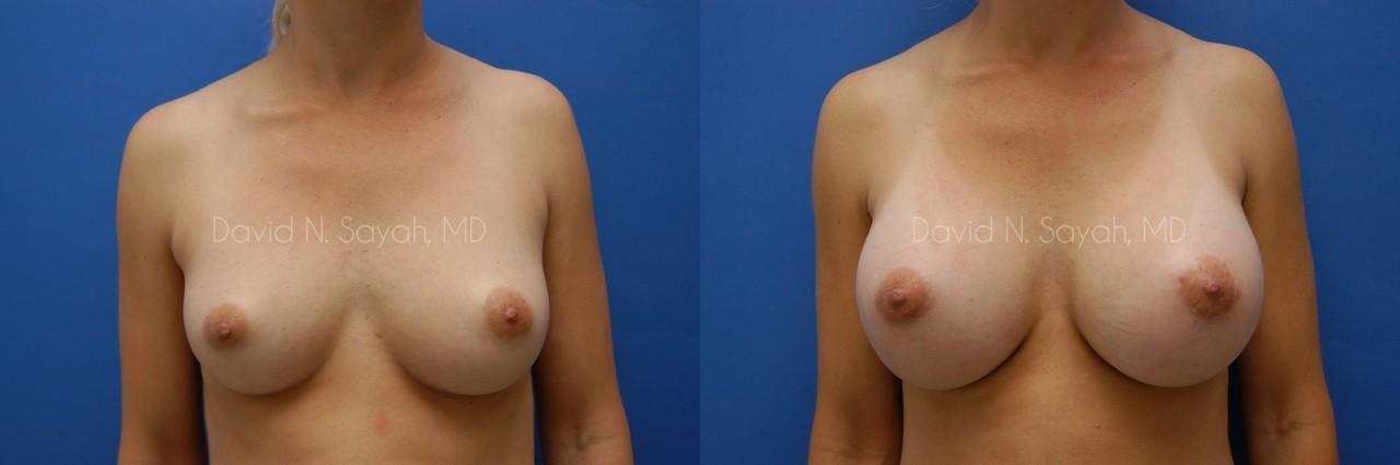 Breast Augmentation Before and After | Sayah Institute