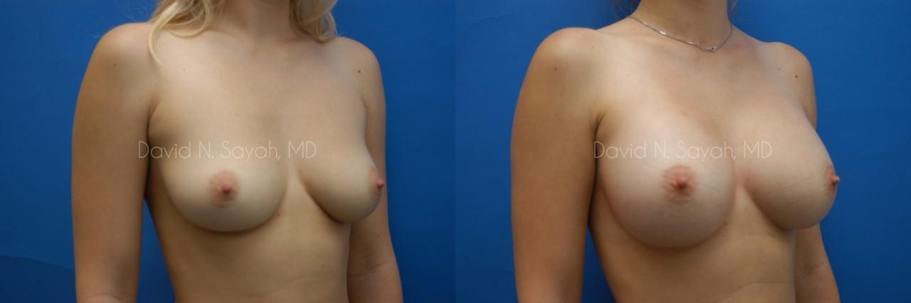 Breast Augmentation Before and After | Sayah Institute