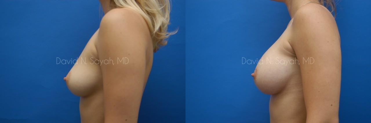 Breast Augmentation Before and After | Sayah Institute