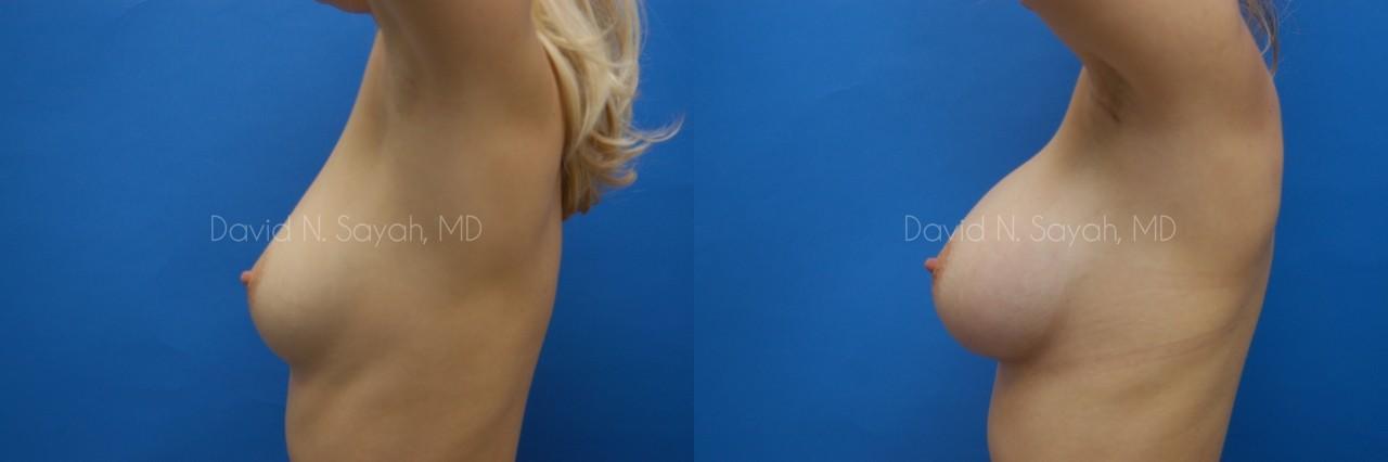 Breast Augmentation Before and After | Sayah Institute