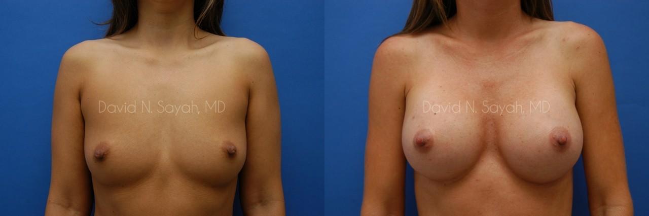 Breast Augmentation Before and After | Sayah Institute
