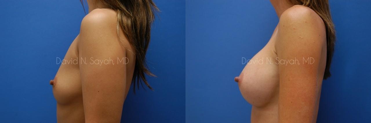 Breast Augmentation Before and After | Sayah Institute