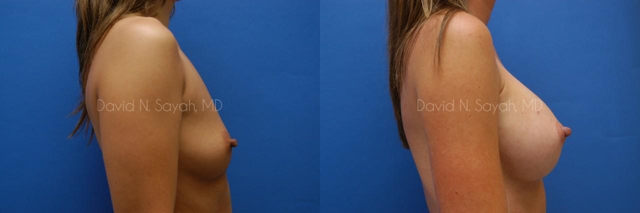 Breast Augmentation Before and After | Sayah Institute