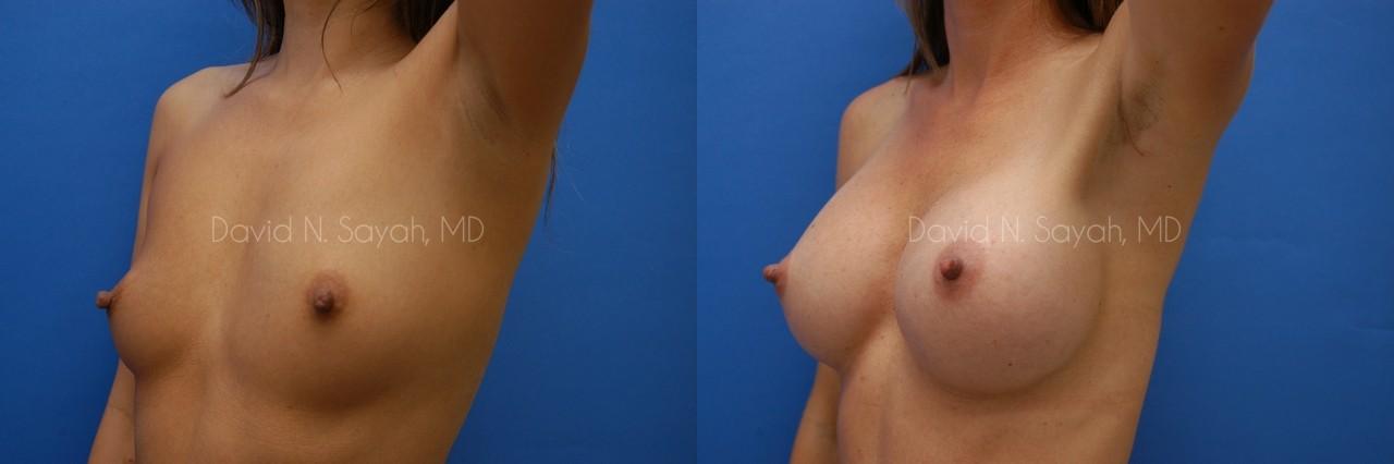 Breast Augmentation Before and After | Sayah Institute