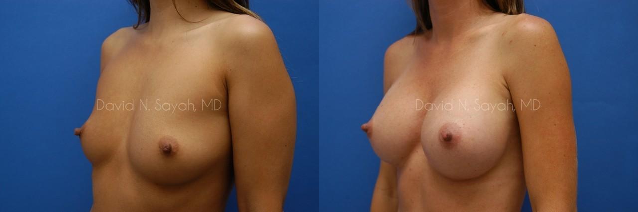 Breast Augmentation Before and After | Sayah Institute