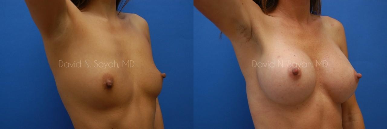 Breast Augmentation Before and After | Sayah Institute