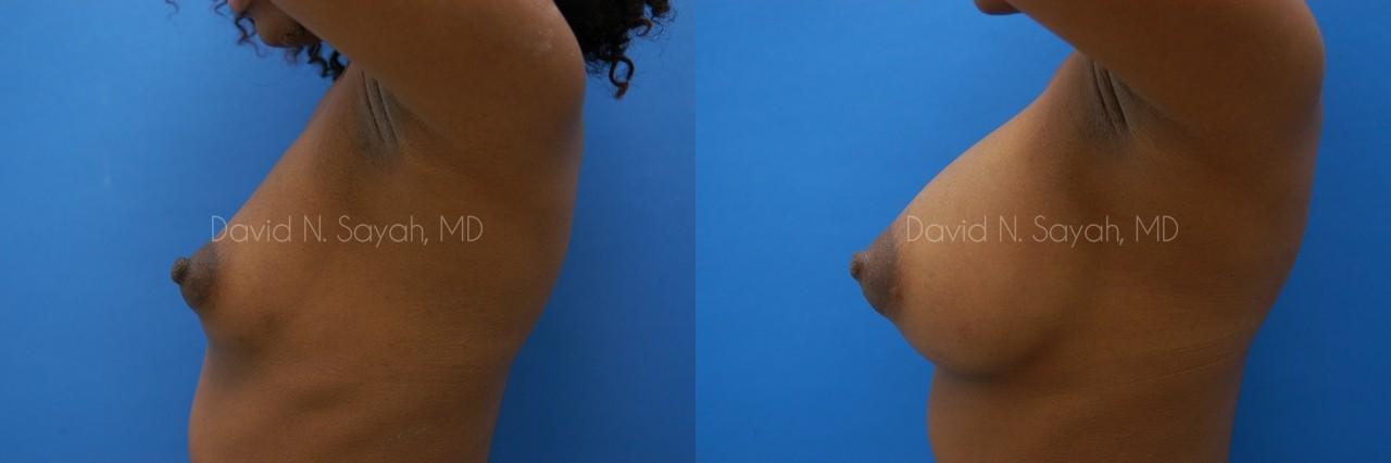 Breast Augmentation Before and After | Sayah Institute