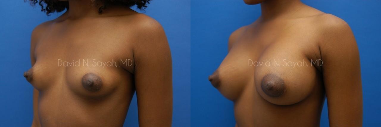 Breast Augmentation Before and After | Sayah Institute