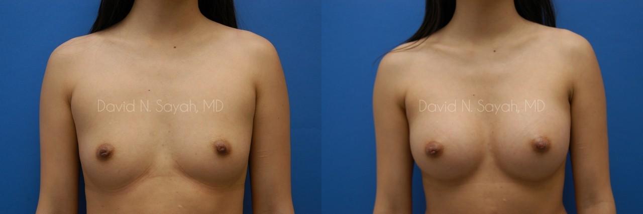 Breast Augmentation Before and After | Sayah Institute