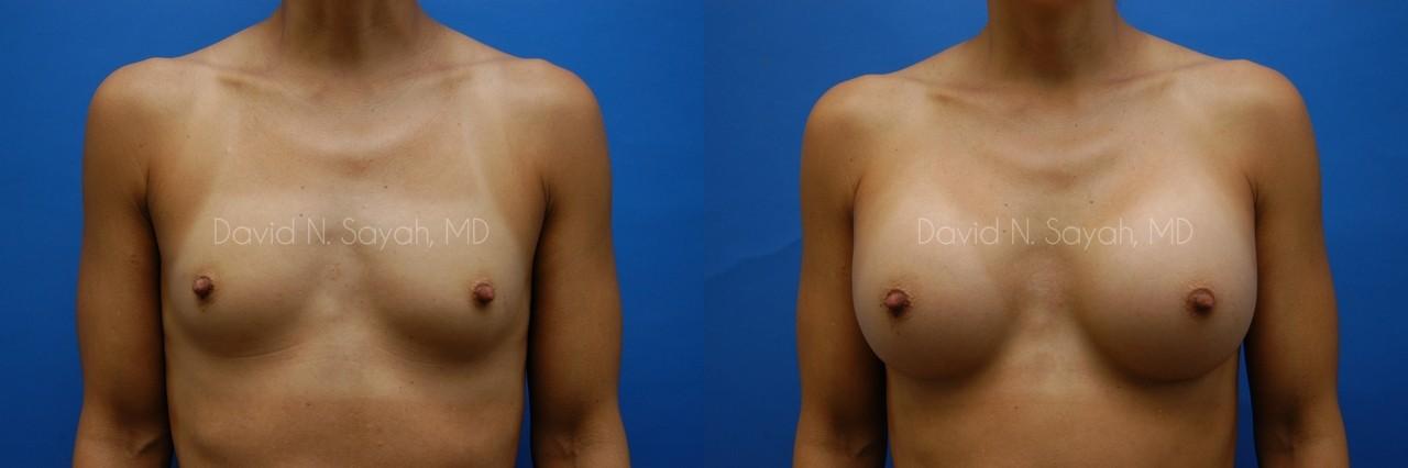 Breast Augmentation Before and After | Sayah Institute