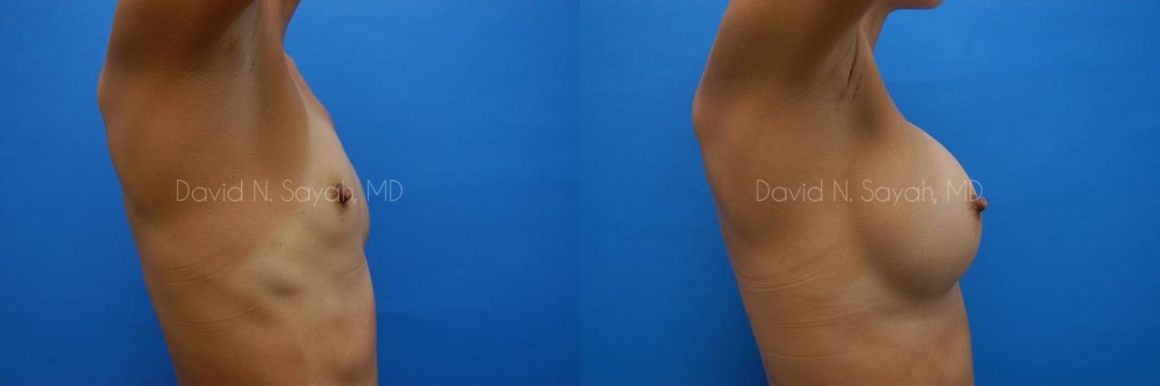 Breast Augmentation Before and After | Sayah Institute