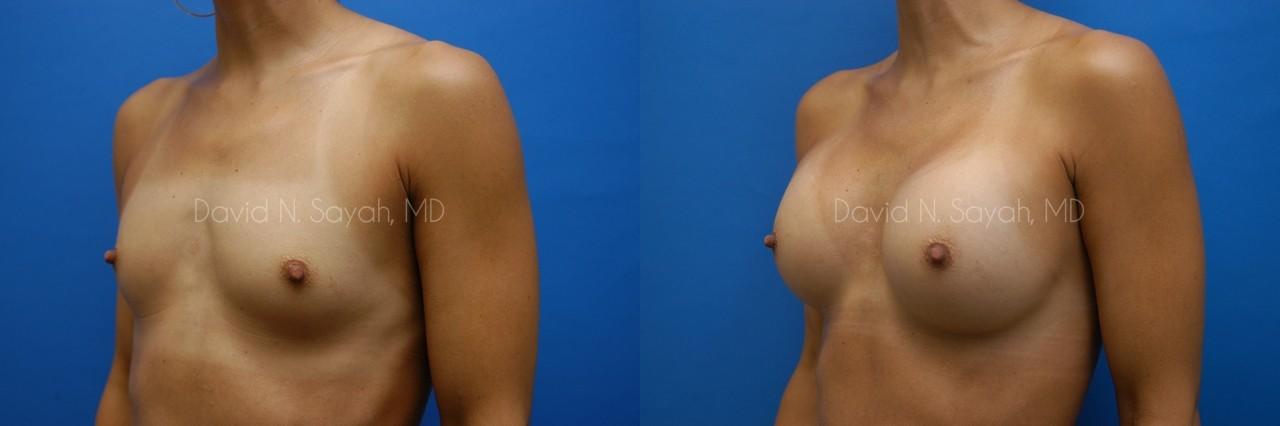 Breast Augmentation Before and After | Sayah Institute