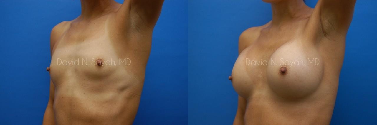Breast Augmentation Before and After | Sayah Institute