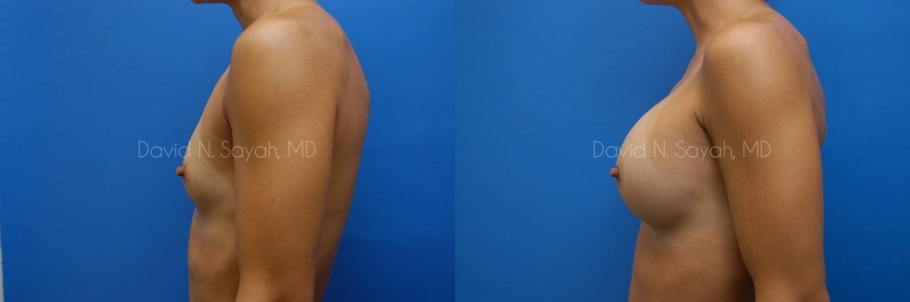 Breast Augmentation Before and After | Sayah Institute