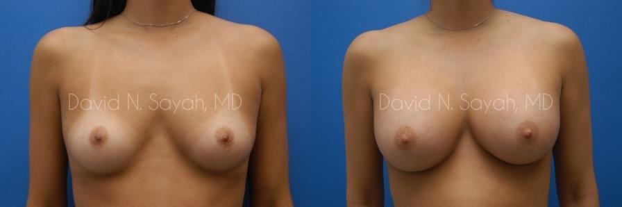 Breast Augmentation Before and After | Sayah Institute