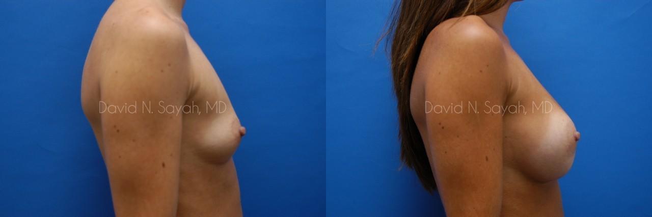 Breast Augmentation Before and After | Sayah Institute