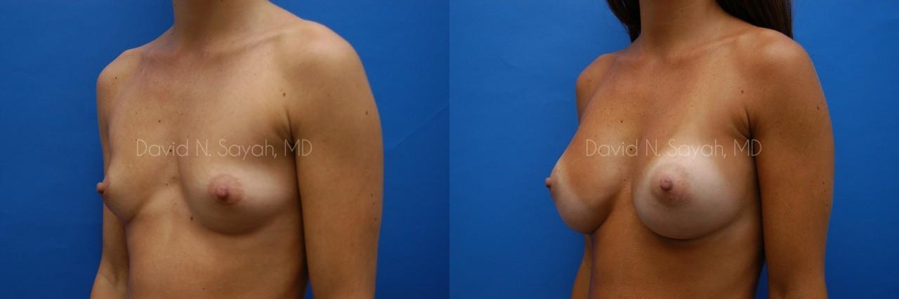 Breast Augmentation Before and After | Sayah Institute
