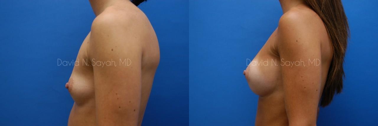 Breast Augmentation Before and After | Sayah Institute