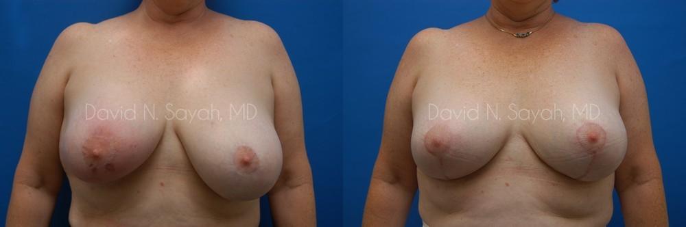 Breast Implant Revision Before and After | Sayah Institute