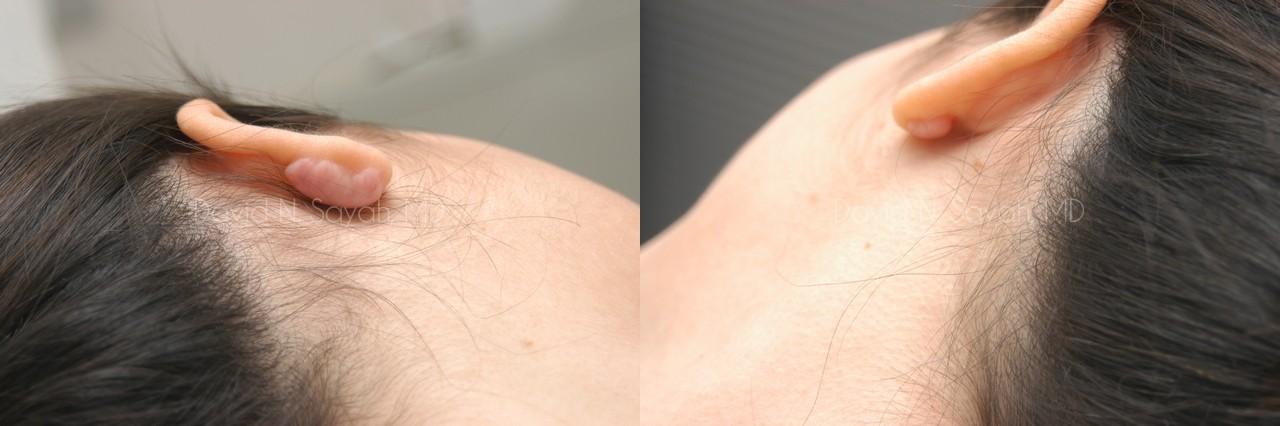 Scar Revision Face Before and After | Sayah Institute