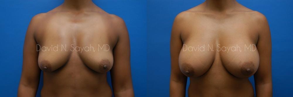 Breast Augmentation Before and After | Sayah Institute