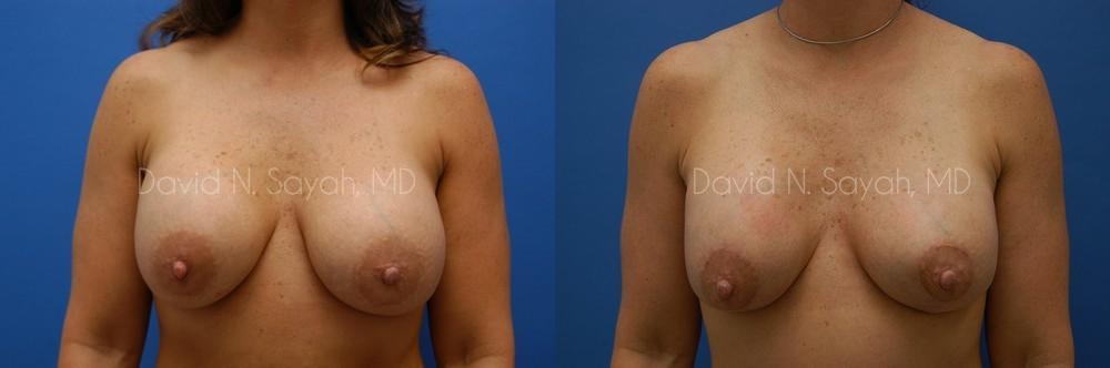 Breast Implant Revision Before and After | Sayah Institute