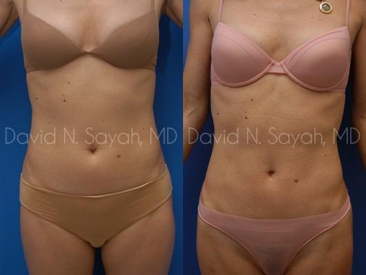 Liposuction Before and After | Sayah Institute