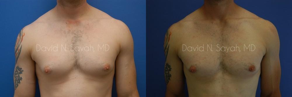 Male Breast Surgery Before and After | Sayah Institute