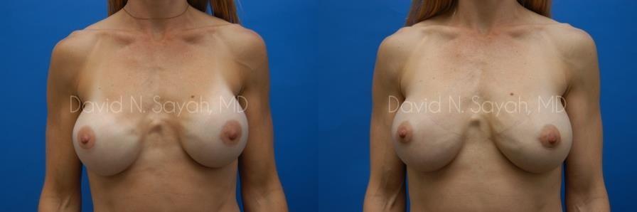 Breast Augmentation And Mastopexy Before and After | Sayah Institute