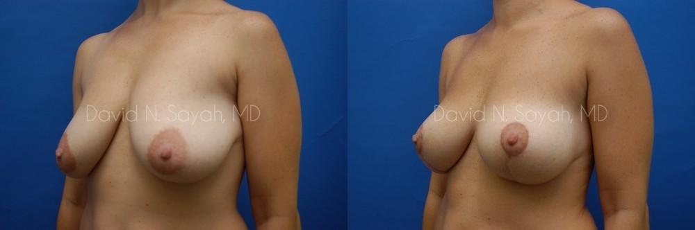 Breast Lift Before and After | Sayah Institute
