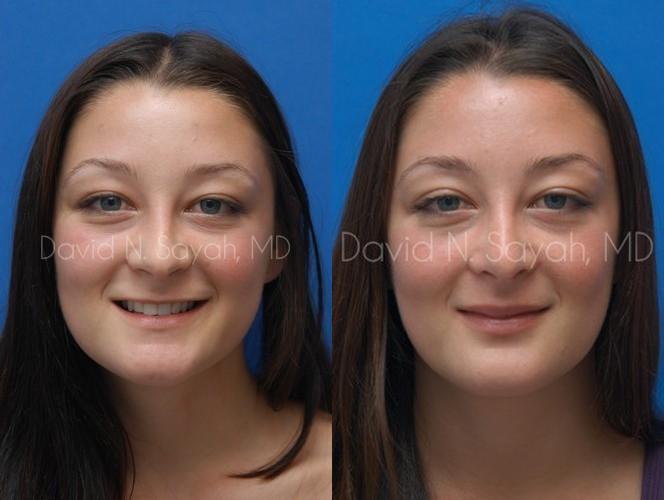Rhinoplasty Before and After | Sayah Institute