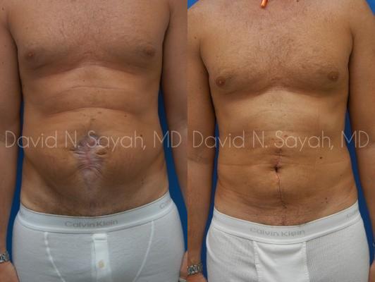 Scar Revision Body Before and After | Sayah Institute