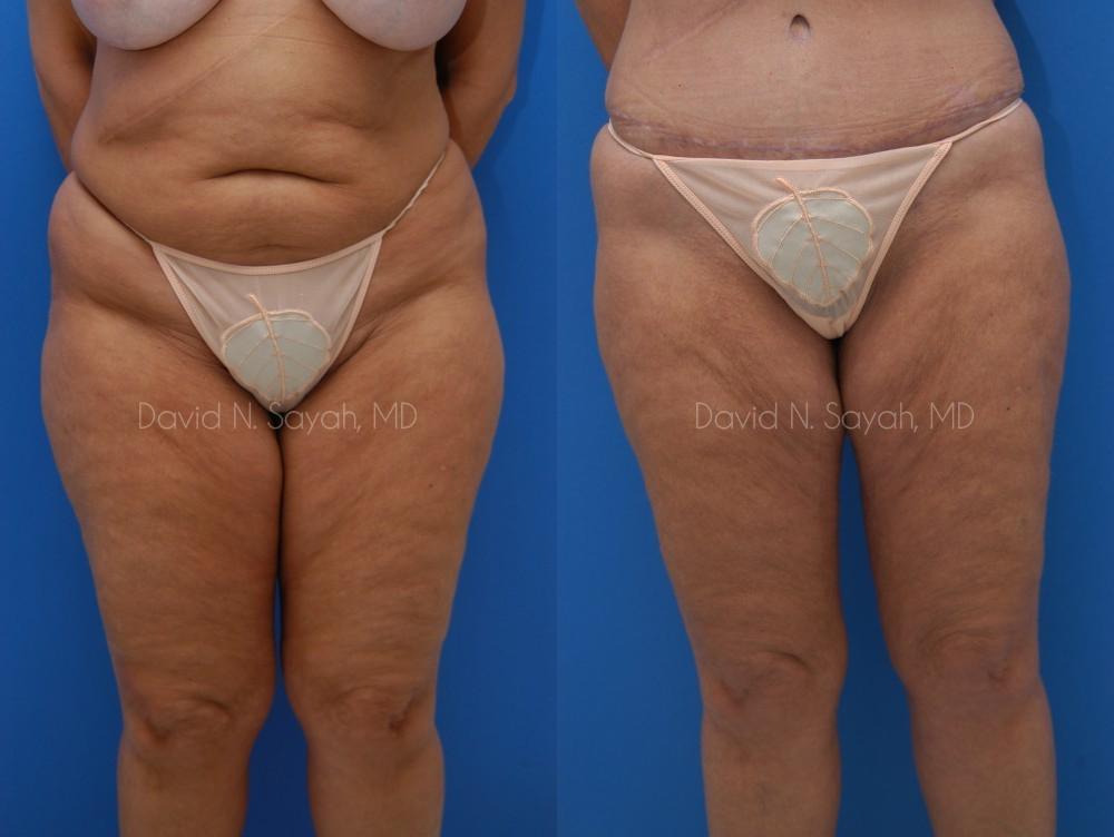 Liposuction Before and After | Sayah Institute
