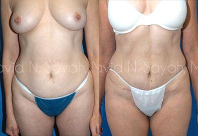 Tummy Tuck Before and After | Sayah Institute